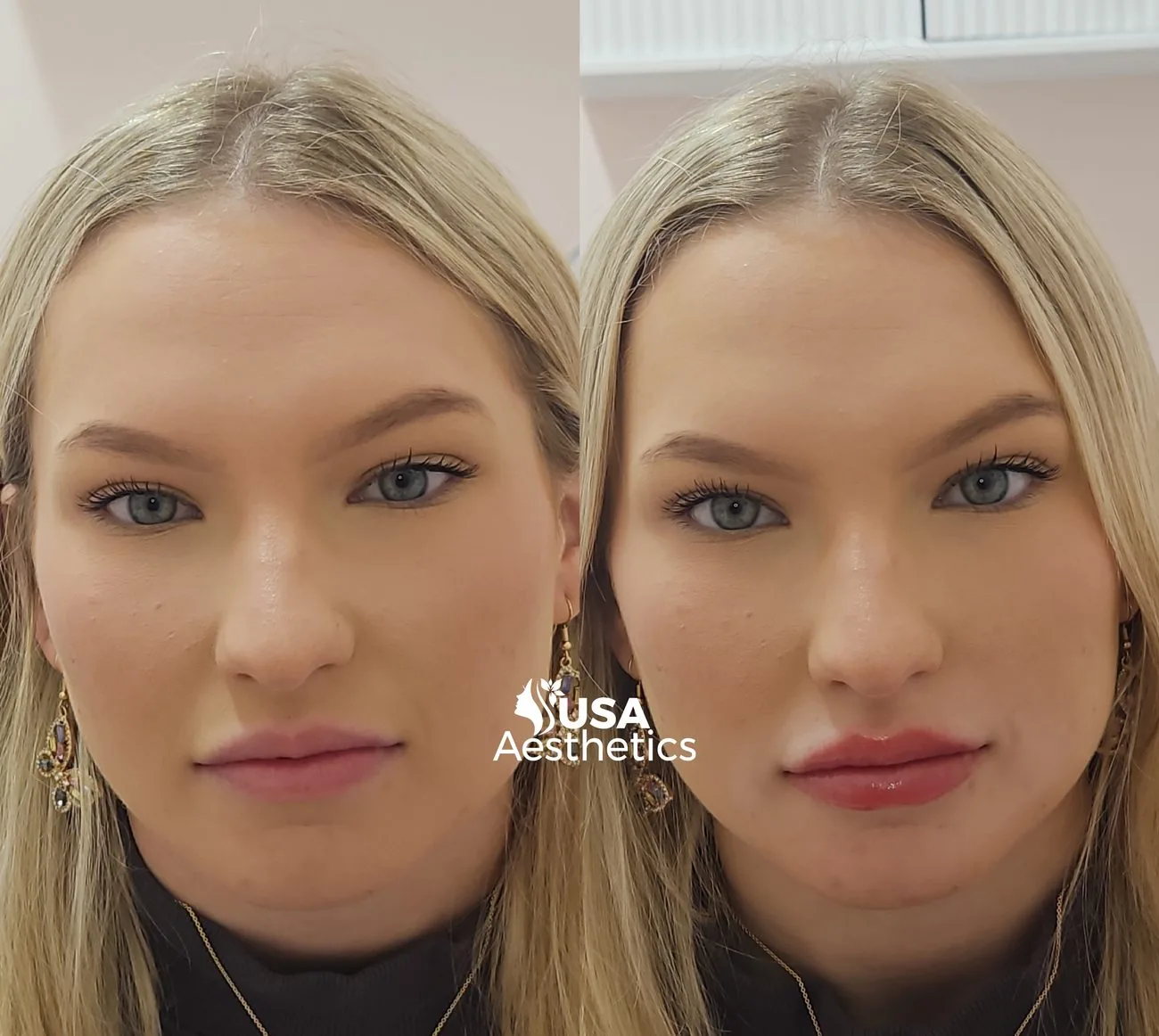 Dermal filler before and after