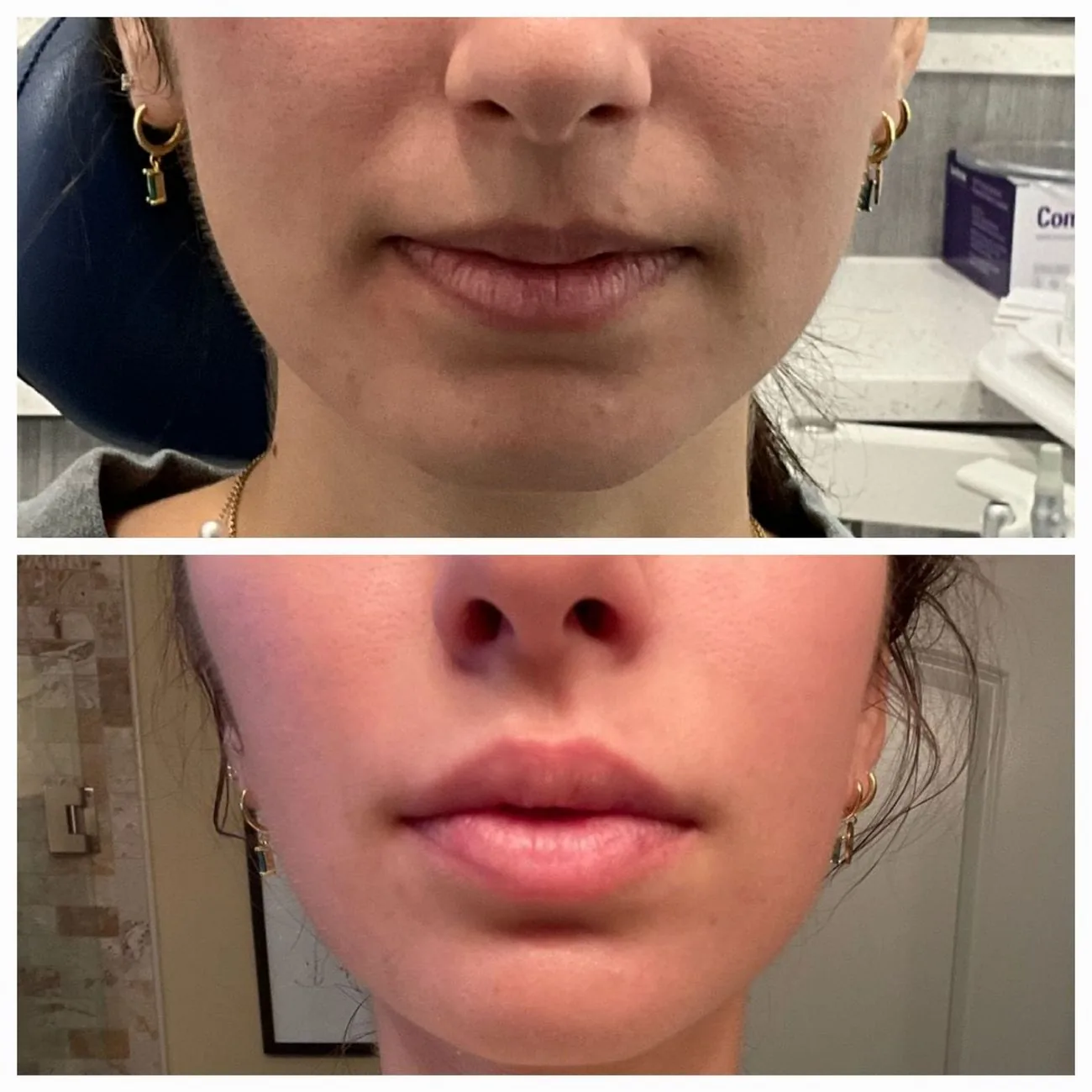 Lip filler before and after