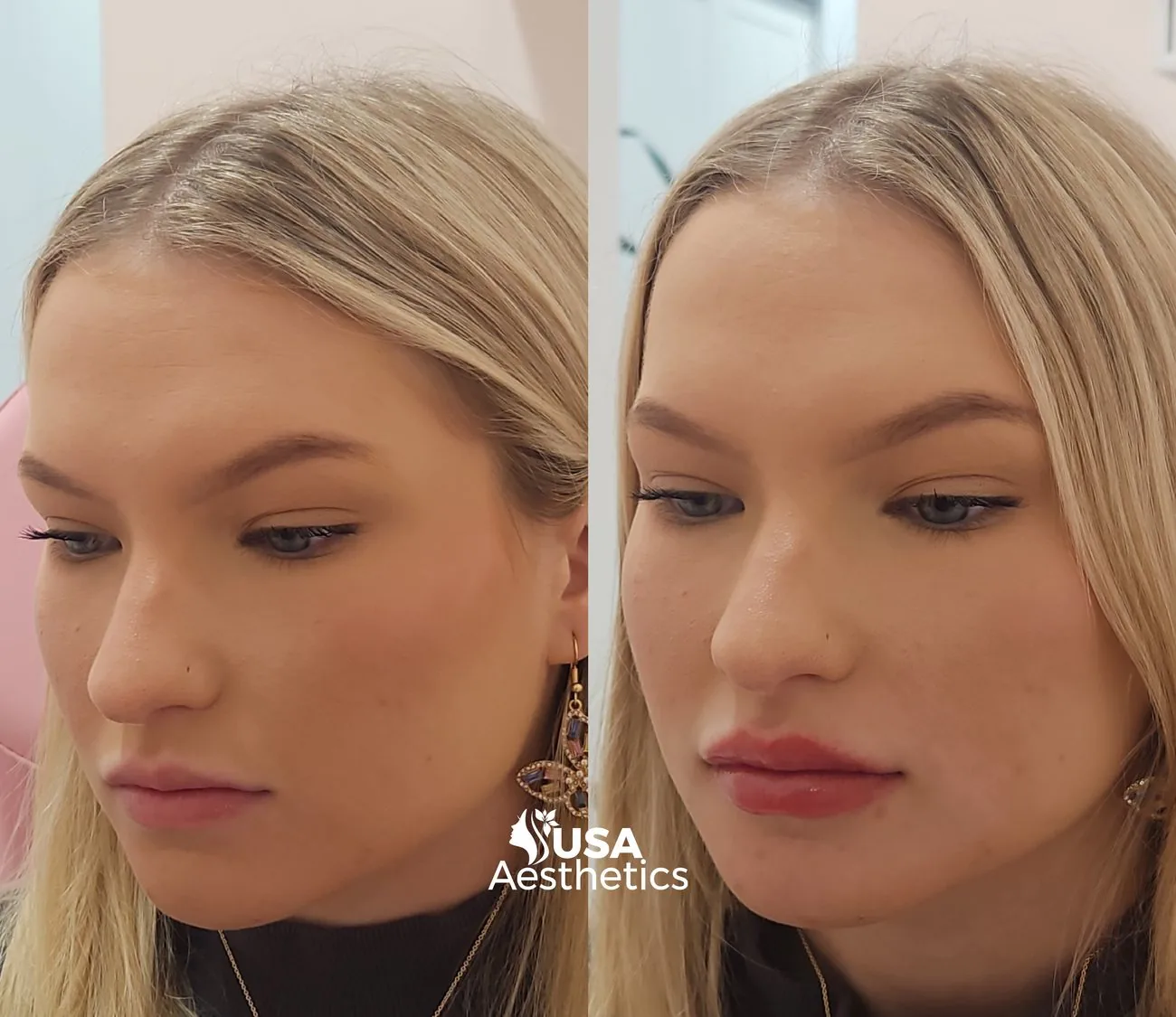Facial balancing before and after
