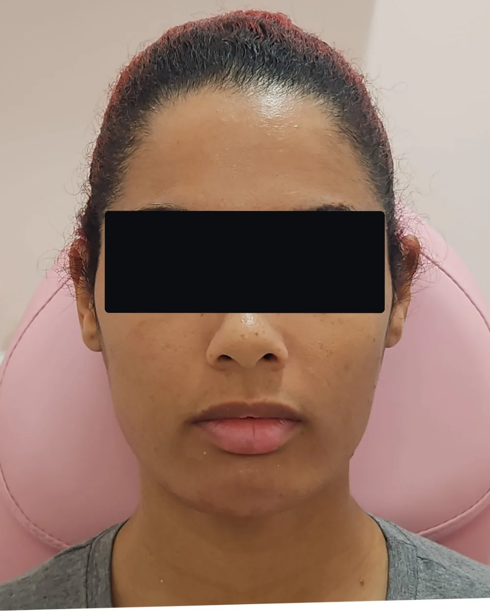 Chin Filler after treatment at USA Aesthetics in Port St. Lucie (patient case 4)