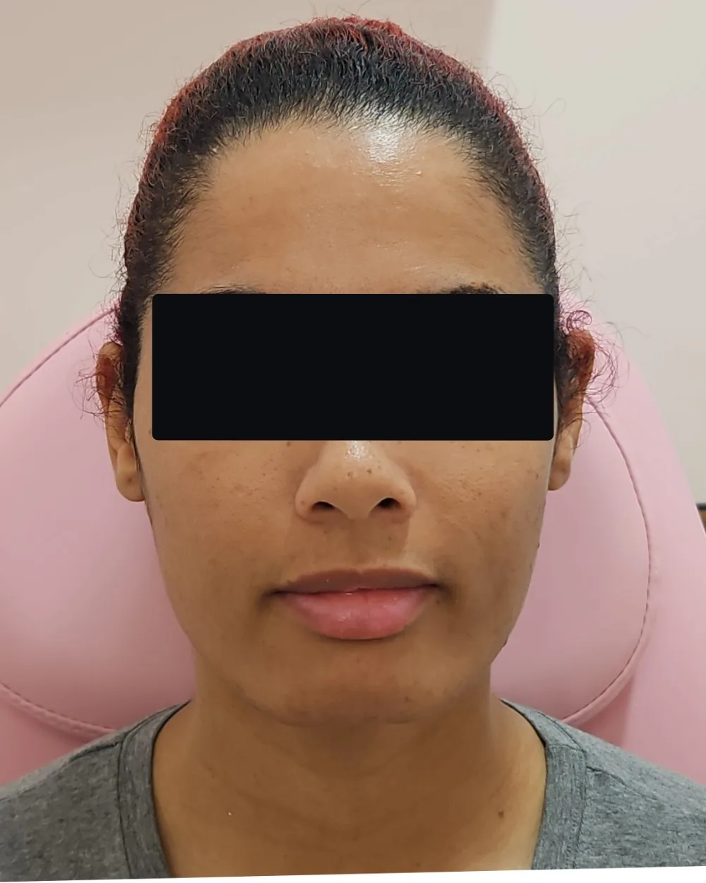 Chin Filler before treatment at USA Aesthetics in Port St. Lucie (patient case 4)