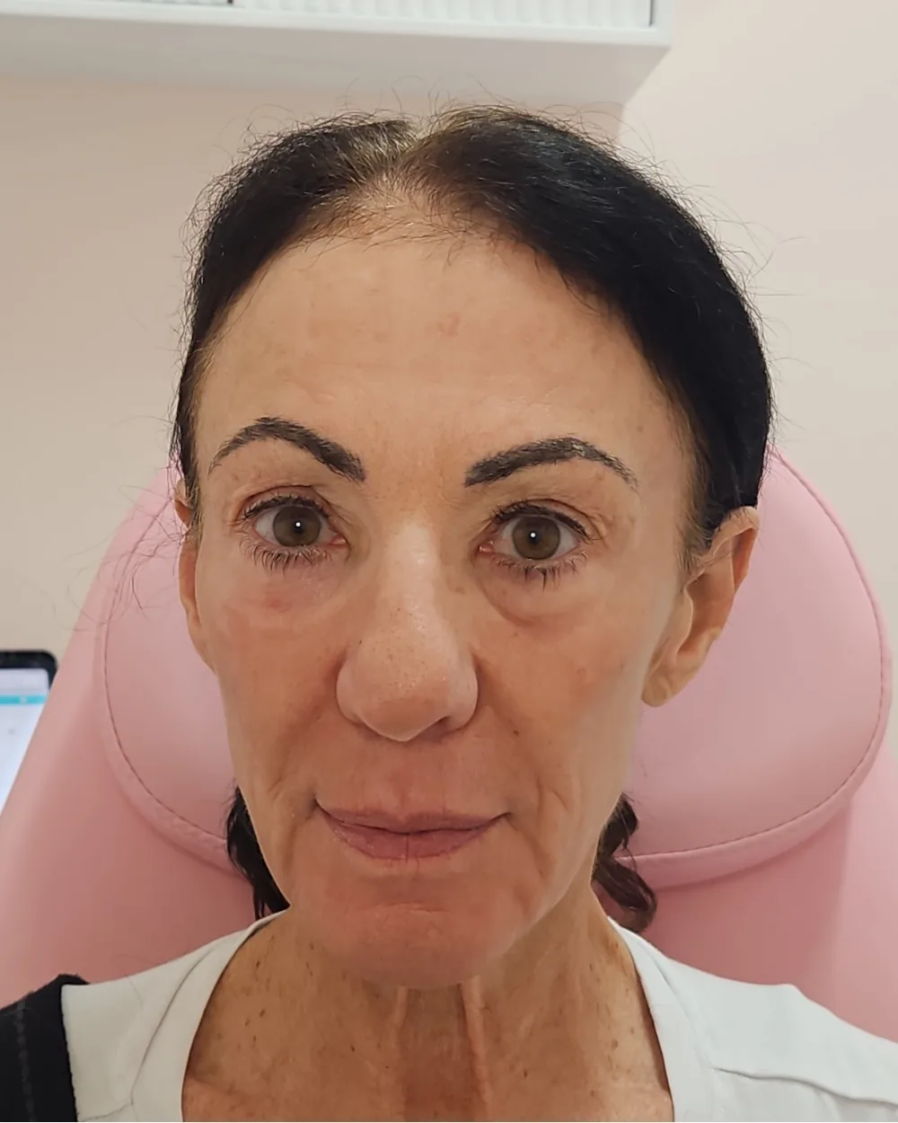 CO2 Laser after treatment at USA Aesthetics in Port St. Lucie (patient case 3)