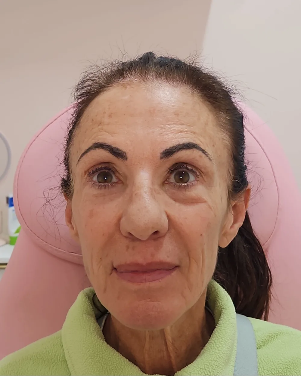 CO2 Laser before treatment at USA Aesthetics in Port St. Lucie (patient case 3)