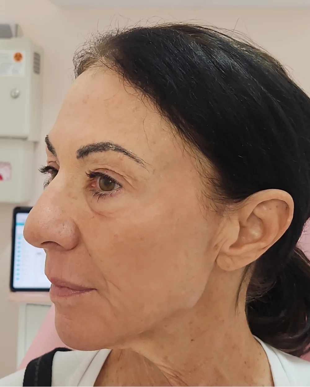 CO2 Laser after treatment at USA Aesthetics in Port St. Lucie (patient case 2)