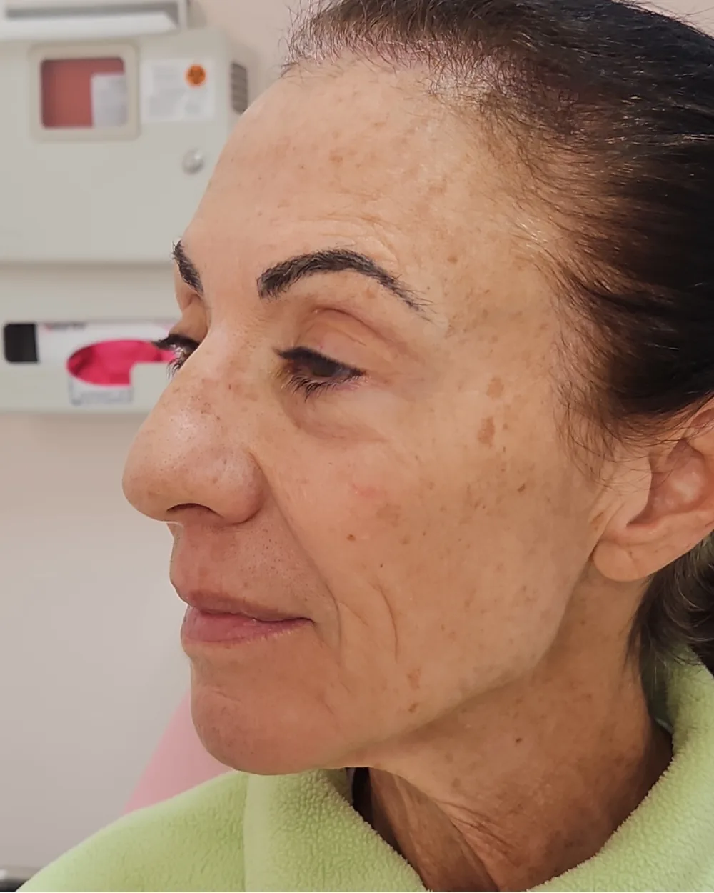 CO2 Laser before treatment at USA Aesthetics in Port St. Lucie (patient case 2)