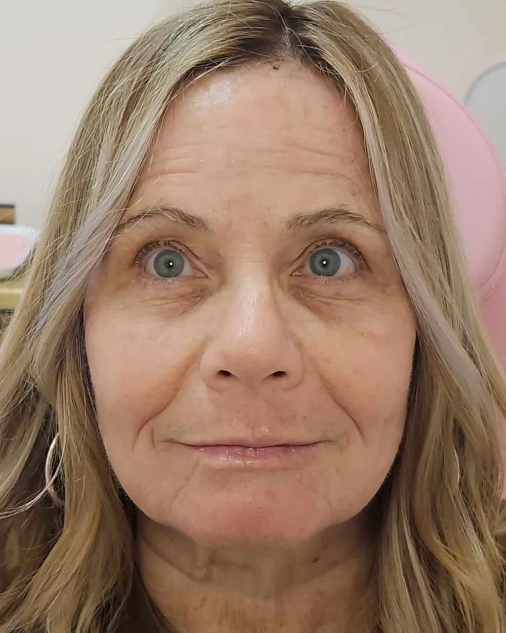 CO2 Laser after treatment at USA Aesthetics in Port St. Lucie (patient case 3)