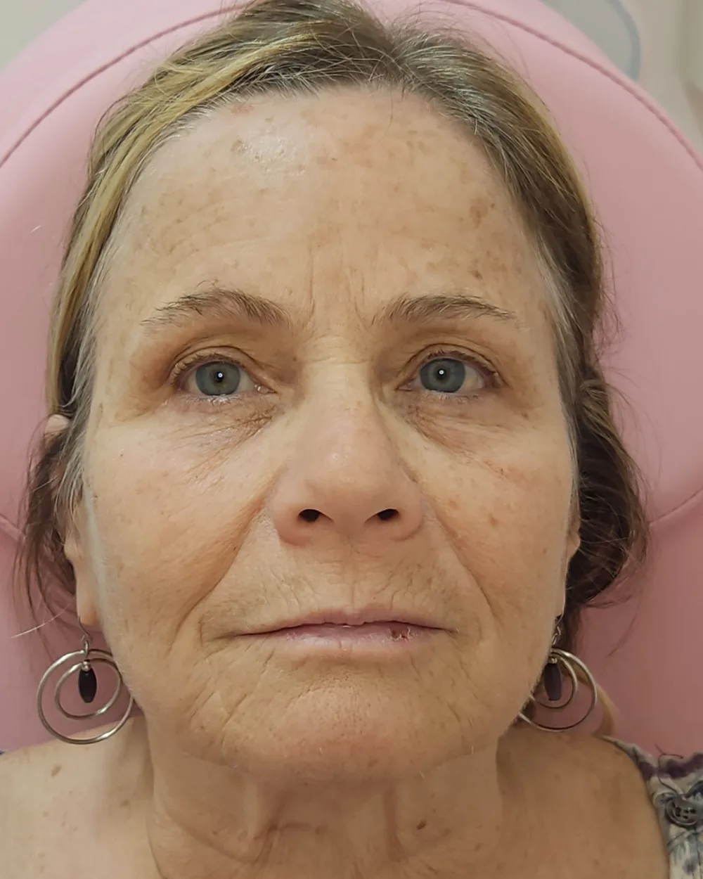 CO2 Laser before treatment at USA Aesthetics in Port St. Lucie (patient case 3)