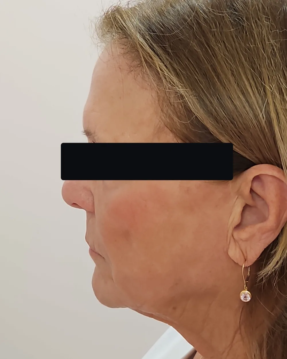 CO2 Laser after treatment at USA Aesthetics in Port St. Lucie (patient case 2)
