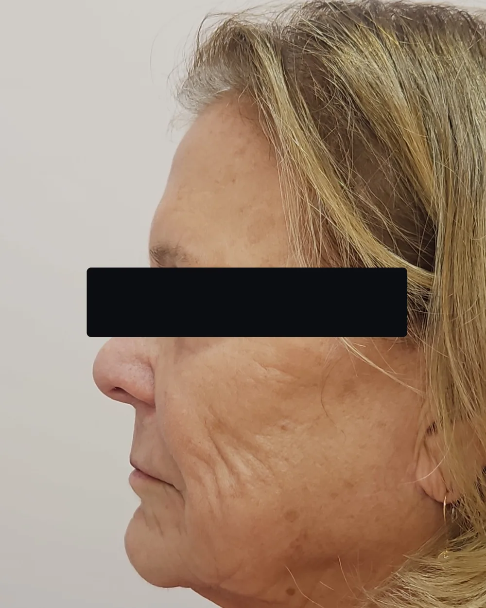 CO2 Laser before treatment at USA Aesthetics in Port St. Lucie (patient case 2)