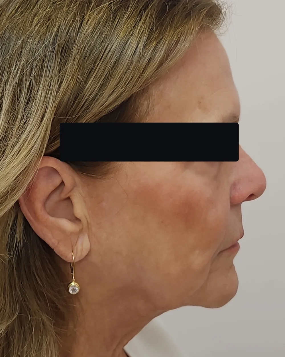 CO2 Laser after treatment at USA Aesthetics in Port St. Lucie (patient case 1)
