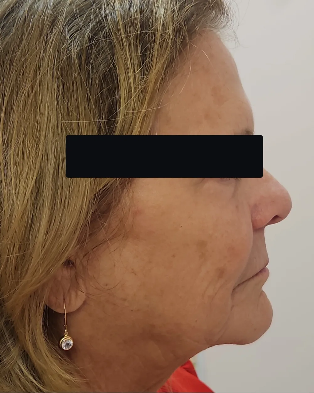 CO2 Laser before treatment at USA Aesthetics in Port St. Lucie (patient case 1)