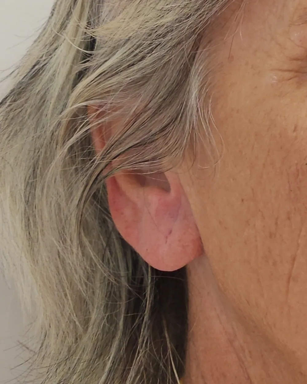 Earlobe after treatment at USA Aesthetics in Port St. Lucie (patient case 1)