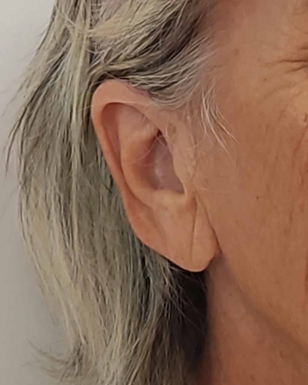Earlobe before treatment at USA Aesthetics in Port St. Lucie (patient case 1)