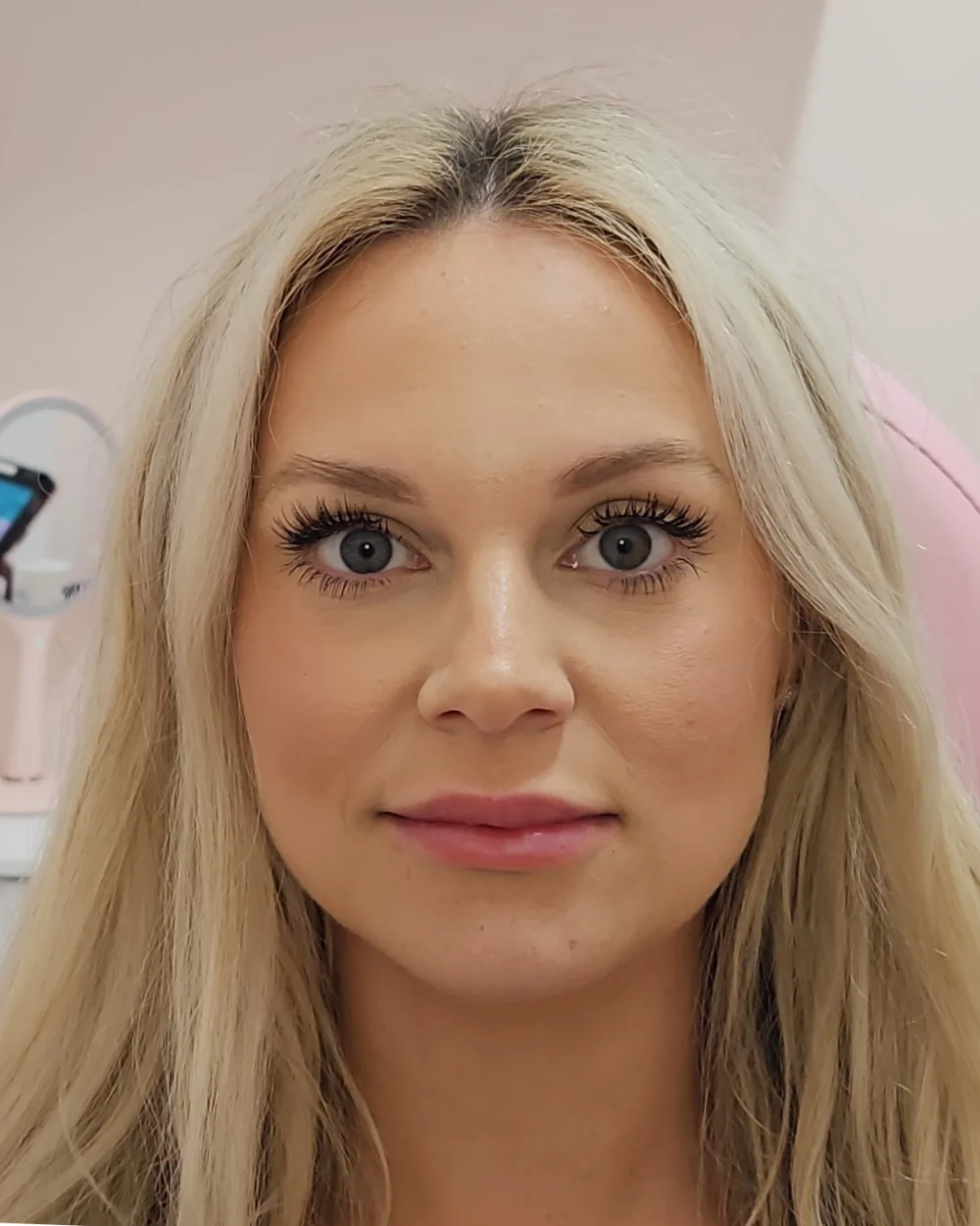 Lip Filler after treatment at USA Aesthetics in Port St. Lucie (patient case 1)