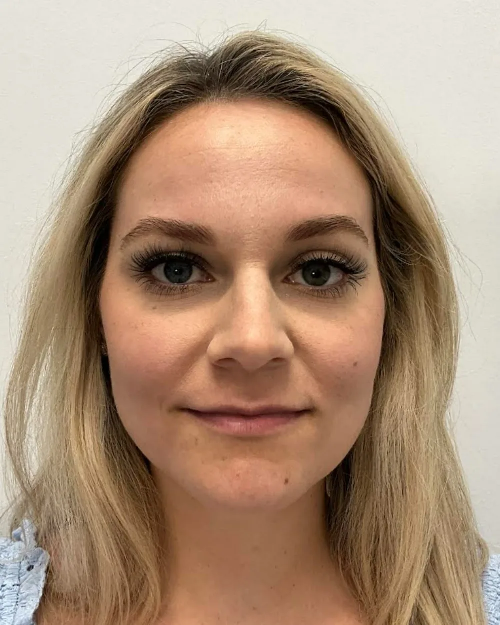 Lip Filler before treatment at USA Aesthetics in Port St. Lucie (patient case 1)
