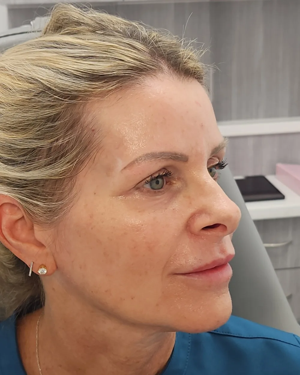 Pico Laser after treatment at USA Aesthetics in Port St. Lucie (patient case 3)