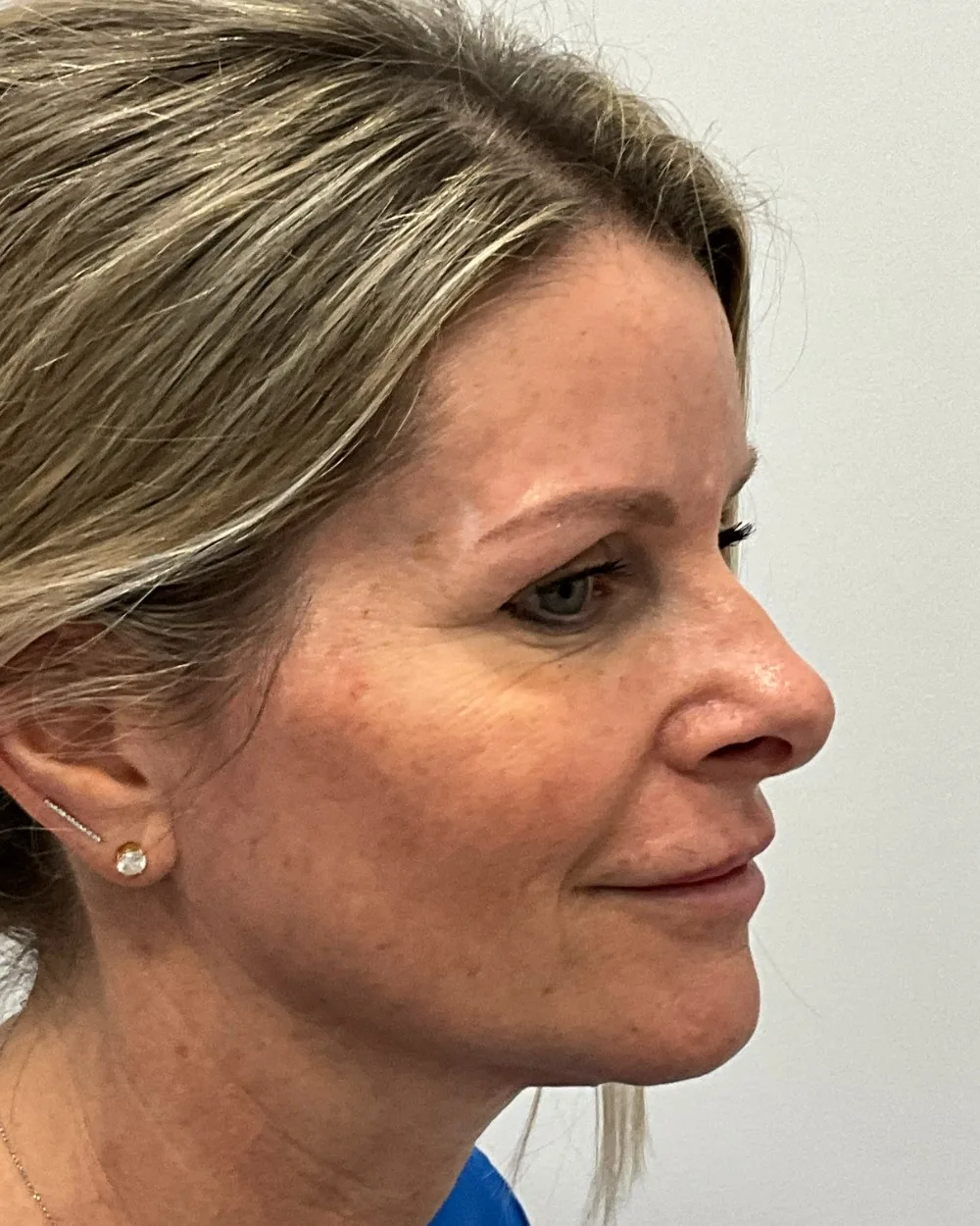 Pico Laser before treatment at USA Aesthetics in Port St. Lucie (patient case 3)
