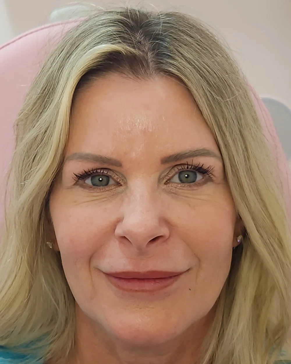Pico Laser after treatment at USA Aesthetics in Port St. Lucie (patient case 2)