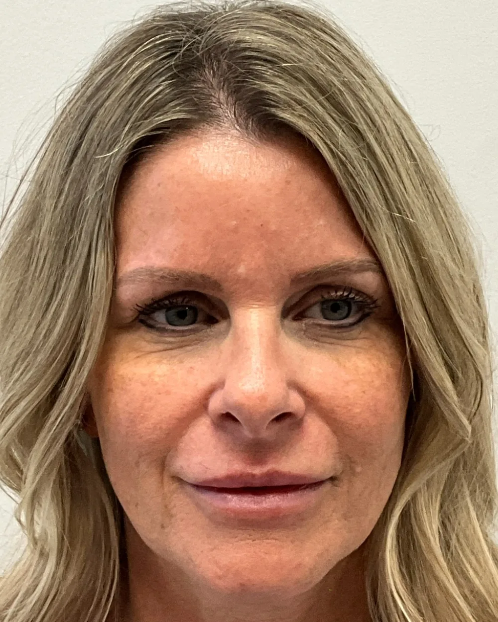 Pico Laser before treatment at USA Aesthetics in Port St. Lucie (patient case 2)