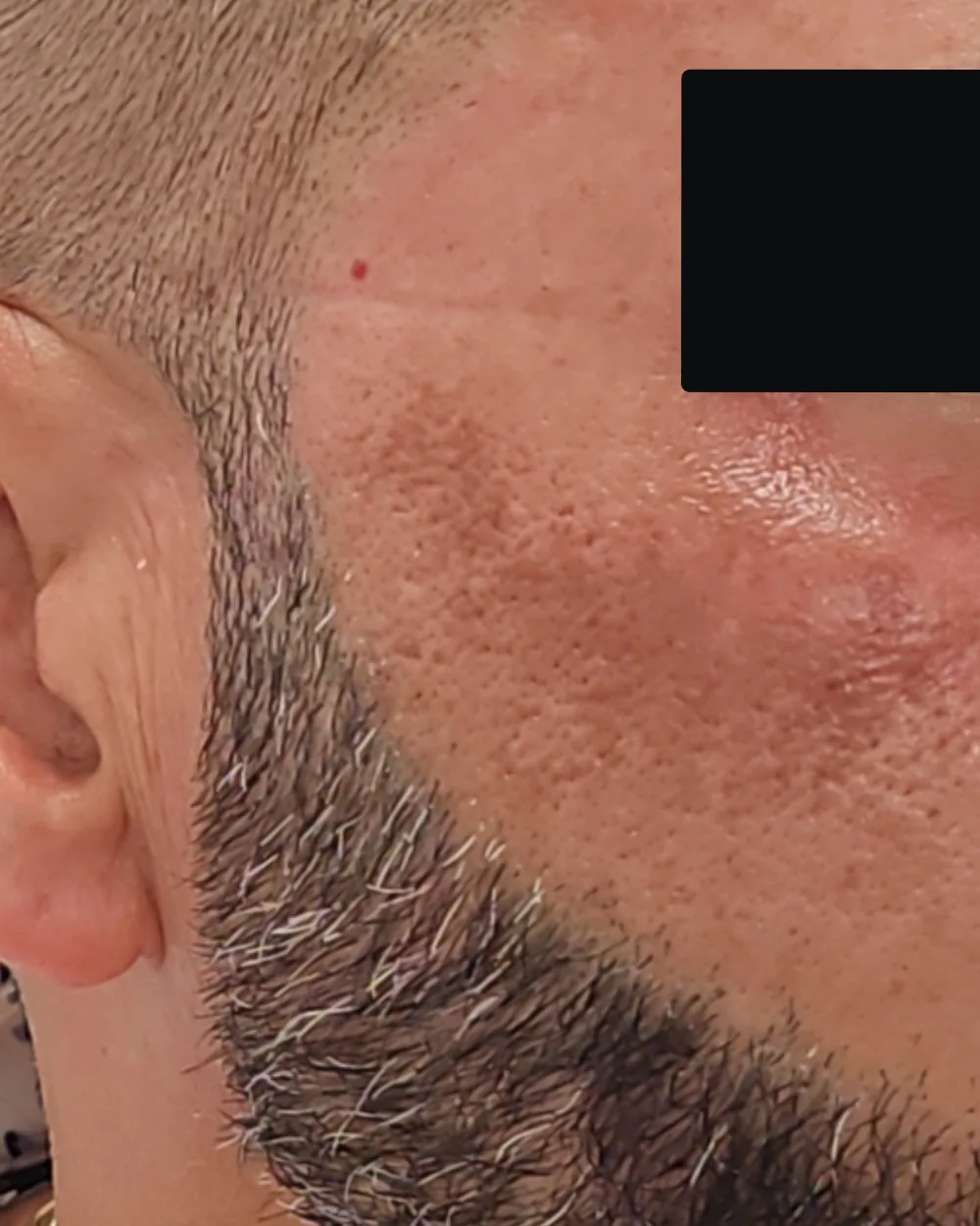 Pico Laser before treatment at USA Aesthetics in Port St. Lucie (patient case 1)