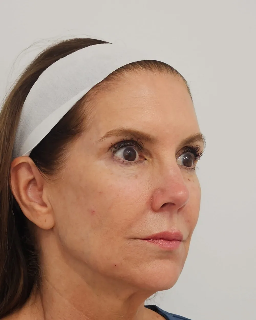 Temple, cheek, jawline and chin filler after treatment at USA Aesthetics in Port St. Lucie (patient case 1)