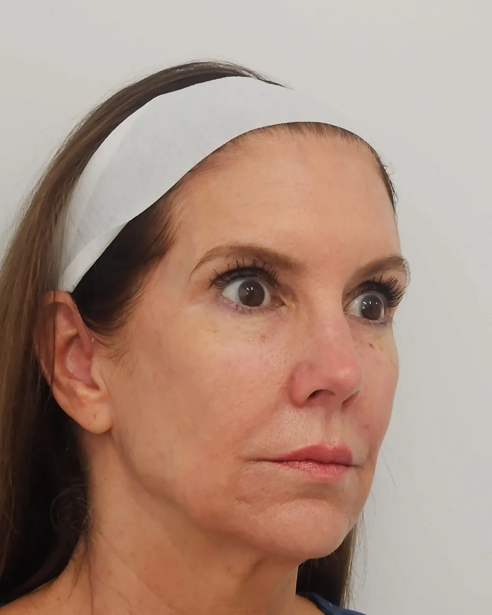 Temple, cheek, jawline and chin filler before treatment at USA Aesthetics in Port St. Lucie (patient case 1)