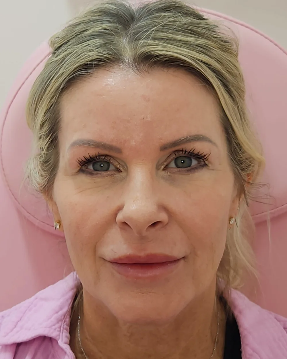 Temple filler after treatment at USA Aesthetics in Port St. Lucie (patient case 2)