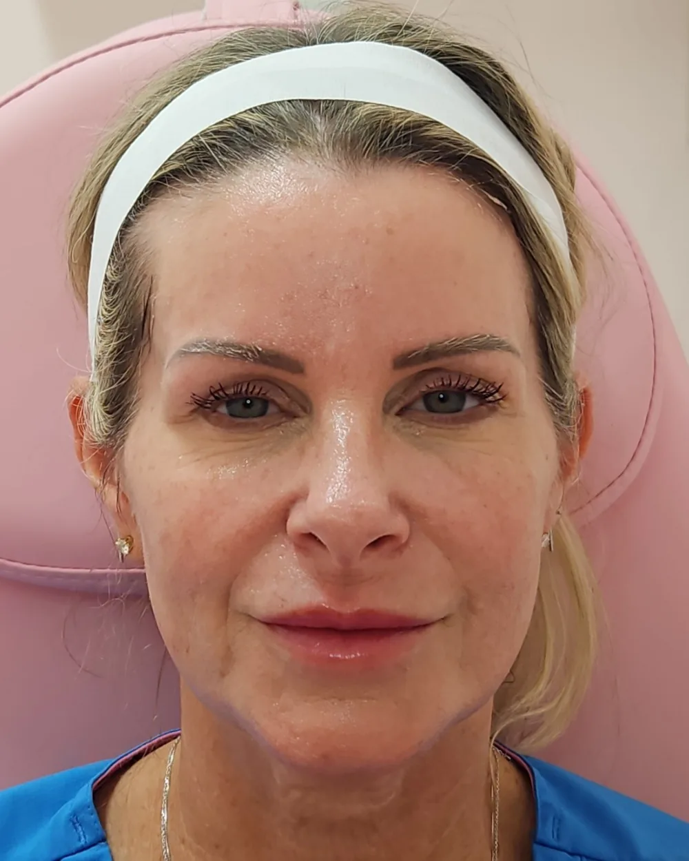 Temple filler before treatment at USA Aesthetics in Port St. Lucie (patient case 2)