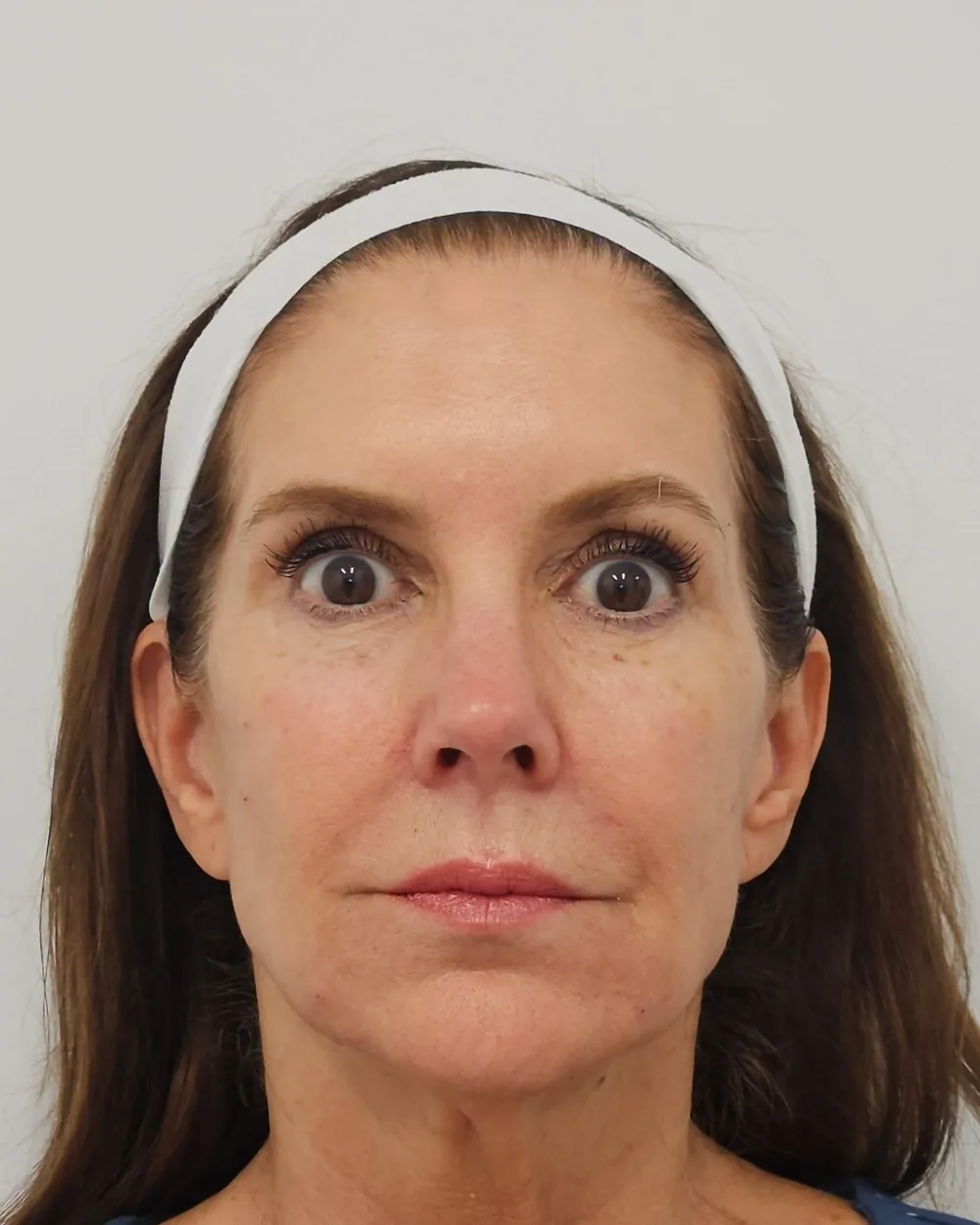 Temple filler, cheek filler, pre sulcus and jawline filler after treatment at USA Aesthetics in Port St. Lucie (patient case 1)