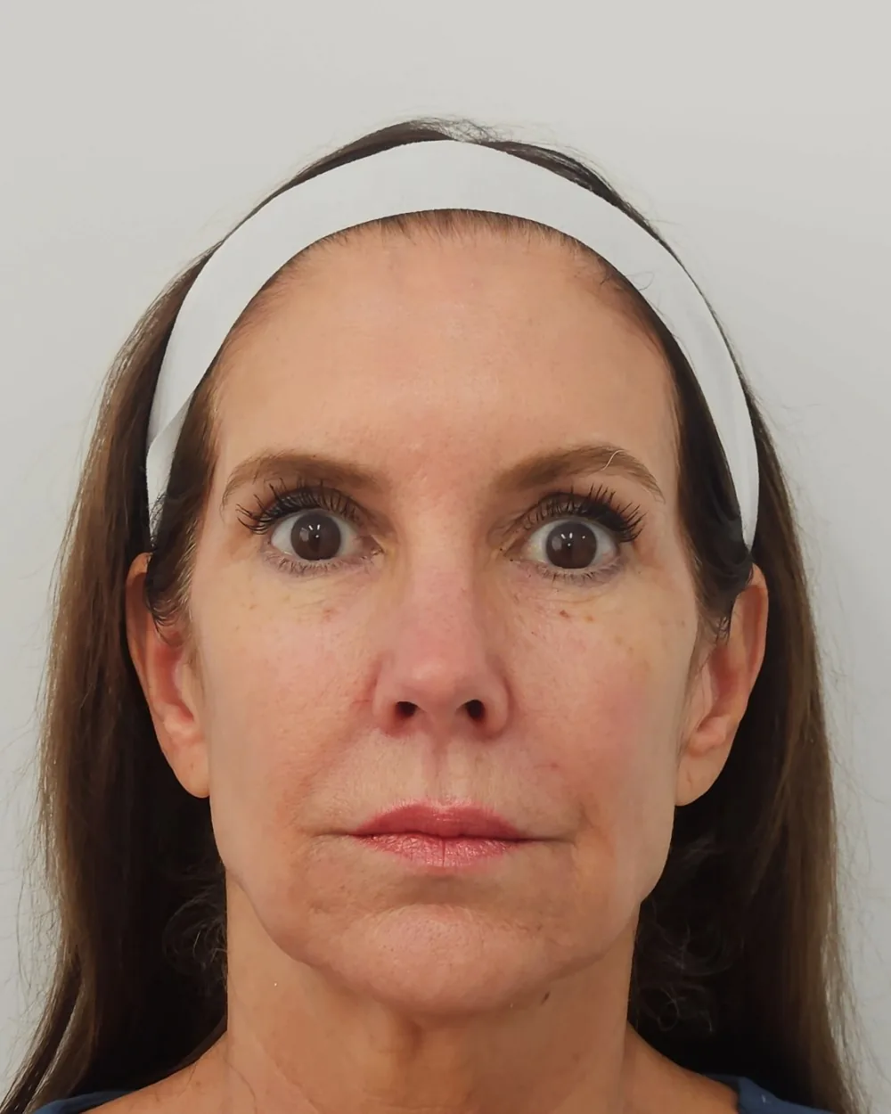 Temple filler, cheek filler, pre sulcus and jawline filler before treatment at USA Aesthetics in Port St. Lucie (patient case 1)